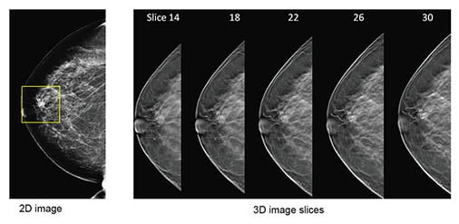 2d vs 3d mammography comparison.