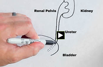 Closeup of a hand drawing an illustration of kidney stones on a piece of paper.