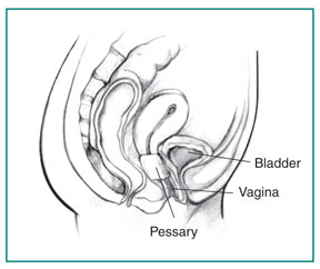 Pessary_insert Cystocele - Pessary insert