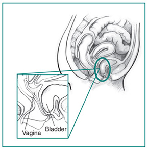 Cystocele Cystocele present, which may require prolapsed bladder surgery